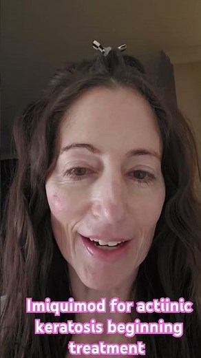 imiquimod for actiinic keratosis beginning treatment