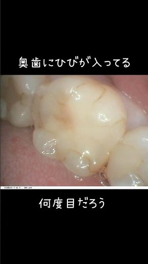 【虫歯治療】何度も欠ける奥歯の治療〜ゴールドインレー治療〜