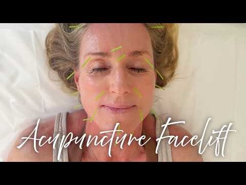I tried Facial/Cosmetic Acupuncture