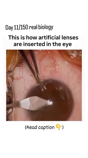 LIFECODE.BIO on Instagram: "Day 11/150 real biology Artificial lenses are inserted into the eye through a surgical procedure called cataract surgery, in which the opaque natural crystalline lens is removed and replaced with a transparent intraocular lens (IOL) to restore normal vision. Process (in biology language): Cataract surgery is performed under local anesthesia to prevent pain. A small incision is made in the cornea or sclera of the eye. The cloudy natural lens is broken into tiny fragmen
