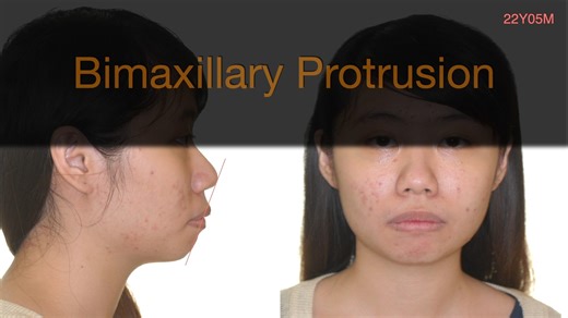 CC830_F169_Posterior X-bite, part II_Bear