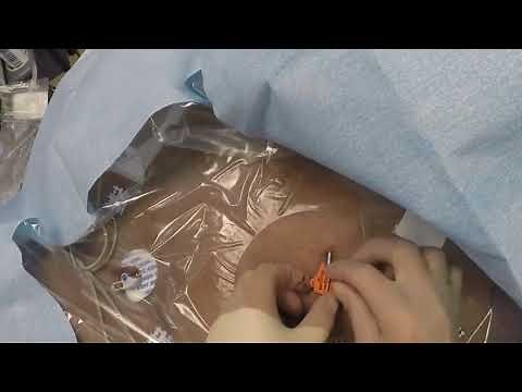 SecurAcath CVC Placement