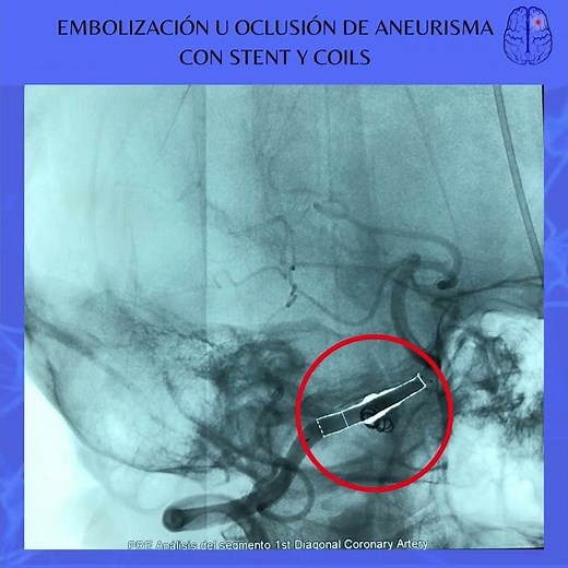 EMBOLIZACION U OCLUSION DE ANEURISMA CON STENT Y COILS Dr Cristobal Salgado NEUROURC