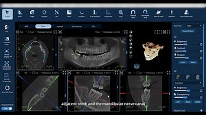 How to accurately locate teeth using the Eighteeth CBCT software? Tune in to this video to explore the procedure of tooth location for the FinScan F350. Stay alert for more information about FinScan's all-inclusive modes! #Eighteeth #EighteethCBCT #DentalImaging #DentalInnovation #FinScanF350 | Eighteeth Medical