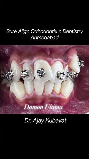 Parallelogram Bracket Power: Damon Ultima Torque Control Simple Biomechanics @ Sure Align Ortho