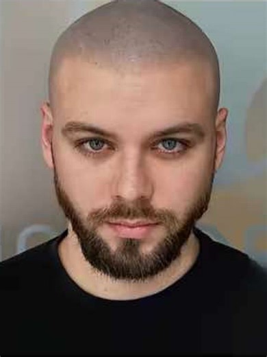 Over 1500 happy clients in the UK. 12 years of SMP experience. Only 5 star Google reviews. Work done by Marcin Adam at MicroHair® Liverpool. Healed and settled matters most. Judge SMP only once it is fully settled. #smp #scalpmicropigmentation #hairtattoo #hairlinetatto #manchester