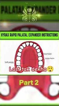 Hyrax Expander Pain, Gap & Care Explained 🦷 | What to Expect After Palatal Expander (Part 2)