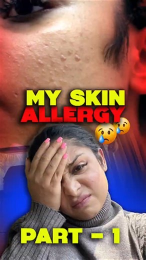 ഫേസ് വാഷ് ഉപയോഗിച്ചു… കിട്ടിയത് പിമ്പിളും വേദനയും മാത്രം 😭 8ന്റെ പണി കിട്ടി #trending #viral #shorts