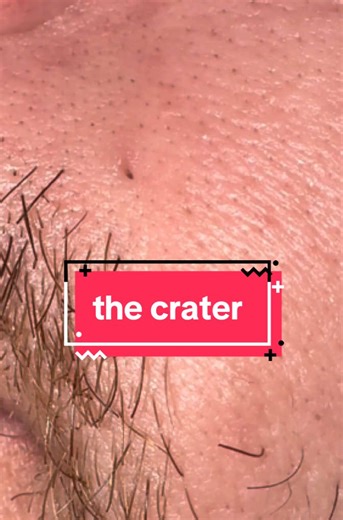 Replying to @Charlene 🤷‍♀️ #dilatedpore #pores #pimplepopper #blackhead #extraction
