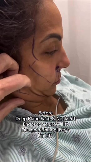 Plastic Surgeon Dr. Kassir on Instagram: "Our beautiful 46-year-old patient is shown two months post-op after seeking a fresher, more youthful look without appearing “too pulled” or like a different person. She wanted to look refreshed while still looking like herself. To address her concerns - including a droopy midface and neck, forehead wrinkles, excess neck and eyelid skin, heavy brows, a droopy nasal tip, uneven lips, and skin texture - we created a tailored surgical plan. Her natural, reju