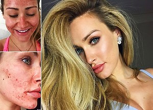 Irish Model Maeve Madden Shares Incredible Pics After Acne Treatment