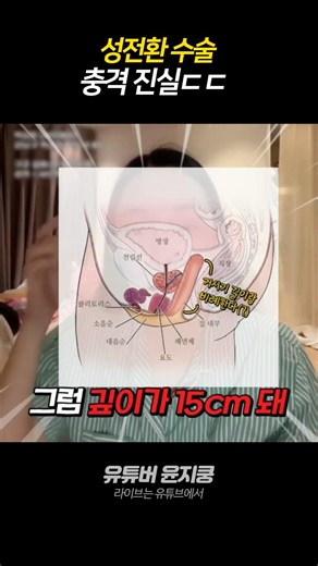 성전환 수술 충격 진실 ㄷㄷ