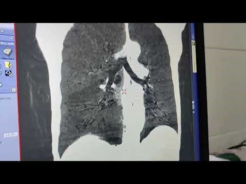 CT GE, chest views- MIP, MIN, AVERAGE