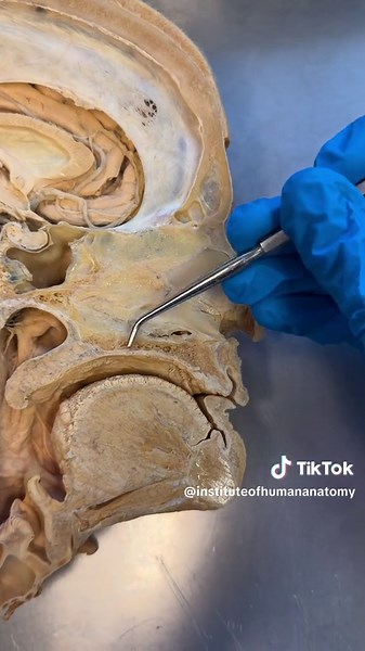A cleft palate is a failure point within embryological development where the maxilla doesnt properly connect. A cleft lip is a similar problem, but instead a failure in connection with the lip. @Max M21 #CleftPalate #CleftLip #Anatomy #ScienceClass