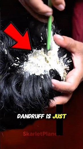 Dandruff Up Close—You’ve NEVER Seen It Like This! 😳🔍 #microscope
