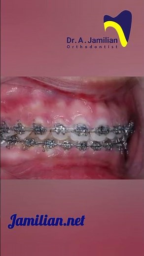 How Orthodontic Treatment Improves Protruding Teeth #dentist #orthodontist #profile #protrading