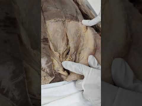 Dissection of Inguinal canal