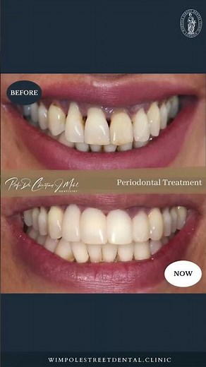 Periodontal Treatment | Before and After
