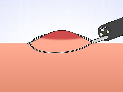 内視鏡的粘膜切除術 EMR（オリンパス「おなかの健康ドットコム」）