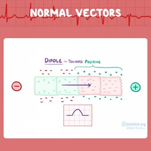When you start learning about ECG, it is important to learn the basics first. Be sure to understand what depolarization and repolarization are, and how the depolarization wave is seen on ECG. Alright, so electrocardiogram, or ECG is based on electrodes that detect charges outside of the cell. At rest, cells are negatively charged compared to the slightly positive outside environment. When they depolarize, they become positively charged, while their environment becomes negatively charged. Now, in