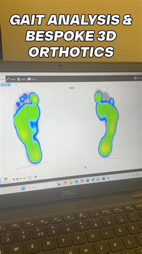 🦶 Your feet are unique – your insoles should be too. Introducing Phits 3D Bespoke Insoles & Gait Analysis 👣 Designed using advanced sports science technology, Phits 3D Insoles are custom-made from your exact foot biomechanics to support every step you take. ✔️ Accurate foot scan using 4,000 pressure sensors ✔️ Detailed gait & pressure analysis ✔️ Precision 3D-printed for long-lasting durability ✔️ Improved comfort, stability & injury prevention Perfect for everyday comfort, sport, and injury m