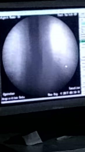 Barium swallow abnormalities