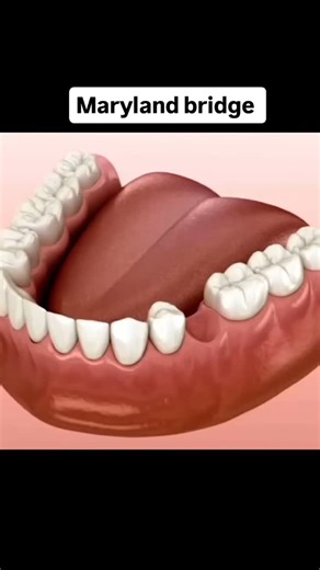 Dent Academy on Instagram: "Maryland Bridge preparation 🦷 Maryland Bridge (Resin-Bonded Bridge) is a non-invasive restoration technique for replacing missing tooth. Instead of using crowns, this bridge uses a metal or porcelain framework with "wings" that are bonded to the back of the adjacent teeth. . . Follow for more ;) . . . #preparation #maryland #marylandbridge #crown #restoration #missingteeth #resin"