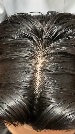 Skin base hair patch Hair Transformation By Apex hair solution 🤝❣️ #hairpatch #Hair #hairproblems #100kviews #hairtransformation #recedinghairline #hairvig #lahore #hairtutorial #confidence