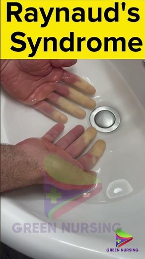 Raynaud's Syndrome