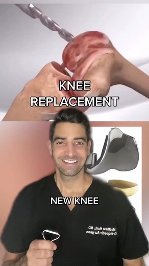 Total Knee Replacement Surgery: Procedure and Recovery