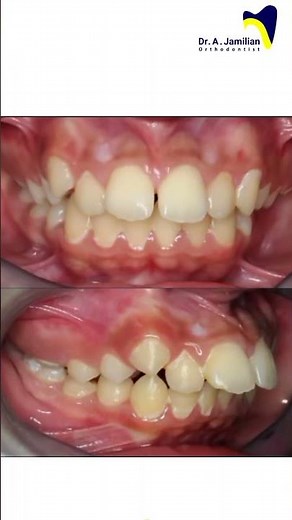 Incredible Smile Transformation: Before and After Orthodontic Treatment for Jaw Misalignment #smile