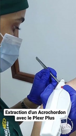 Extraction d'un Acrochordon avec le Plexr Plus. @Familimed