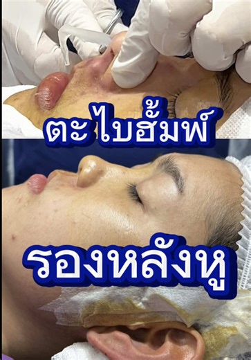 เคส full option ตะไบฮั้ม รองหลังหู #เสริมจมูก #วาโยคลินิก #เสริมจมูกขอนแก่น #รีวิวเสริมจมูก #พี่หมอรินวาโยคลินิก