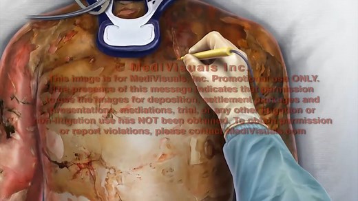 Escharotomy Surgery - R25043