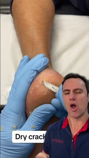 Heal Cracked Heels Fast: Expert Scalpel Debridement Guide #Podiatry #FootCare