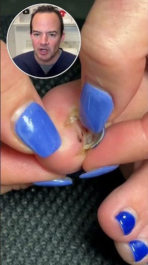 DOCTOR REACTS: Toenail falling off! 😱 #shorts