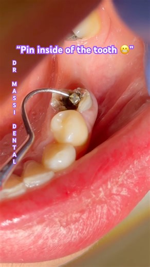 “Pin inside of the tooth 😬”