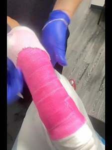 I cried and cried last night after I visited the #orthopedist in the #hospital . It was so sad frustrating I felt so vulnerable, feeling so down ….. I have not feel like this way ever, just somehow take me a long time to get myself out of this mood, not totally yet don’t know what to do!I have never had anything broken like this. It’s a long video just want to keep it as a memory. If you watch to the end you will learn something about how to treat when bone broken. I know is this got me upset , 