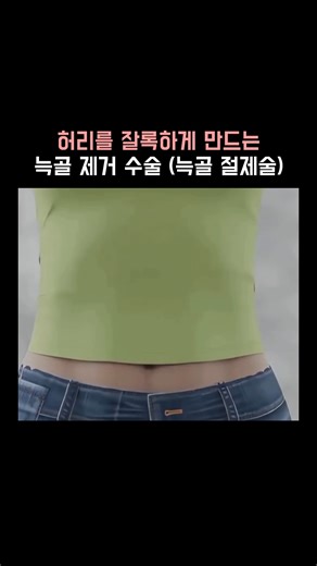 생물학 | 의학 | 건강 모음집 | 늑골 절제술(Rib Removal Surgery, Rib Resection)은 갈비뼈의 일부를 외과적으로 제거하는 수술입니다. 이 수술은 주로 흉곽출구증후군(Thoracic Outlet Syndrome, TOS) 같은 질환을 치료하거나, 가슴 부위... | Instagram