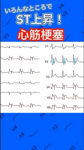 色んなところでST上昇！？どこが詰まっているか分かりますか？#心電図検定 #心電図 #看護師 #訪問看護 #医学生