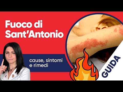 Fuoco di Sant’Antonio: cause, sintomi e rimedi