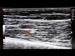 Ultrasound of muscle twitch