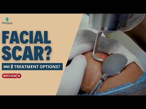 CO2 Laser for Facial Trauma Scar | Know the Treatment options? | SkinQure