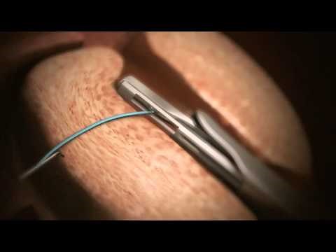 Animation of Urolift® System for BHP - Treatment now available at Genesis Healthcare
