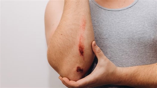 Treating Wounds Faster: Try These Home Remedies To Promote Faster Recovery