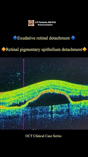 Exudative retinal detachment. Retinal pigmentary epithelium detachment.
