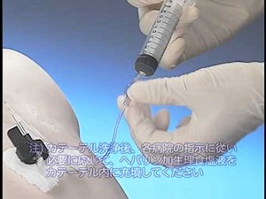 皮下埋込型ポートの管理