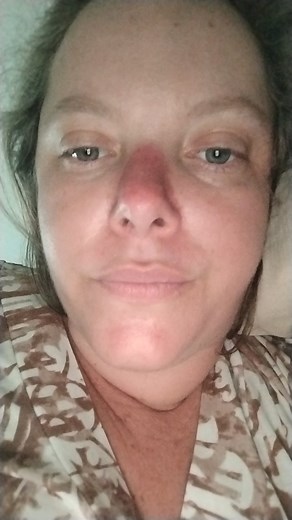Atualização do creme Efurix no tratamento facial