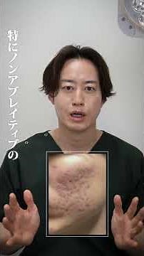 Acne scar treatment: For those with large craters