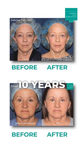 Take 10 years off your appearance with Take10! ✨We combine multiple laser and dermal technologies in one powerful session to target dullness, texture, and visible signs of aging! Click the link in our bio to book your consultation today! 🔗 #cosmeticlaserdermatology #dermatology #CLDerm #meded #take5 #facial #antiaging #laser #facialtreatment | Cosmetic Laser Derm